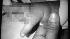 Awalnya Sakit Flu, Tapi Akhirnya Jari Bayi 2 Bulan Diamputasi, Malpraktek