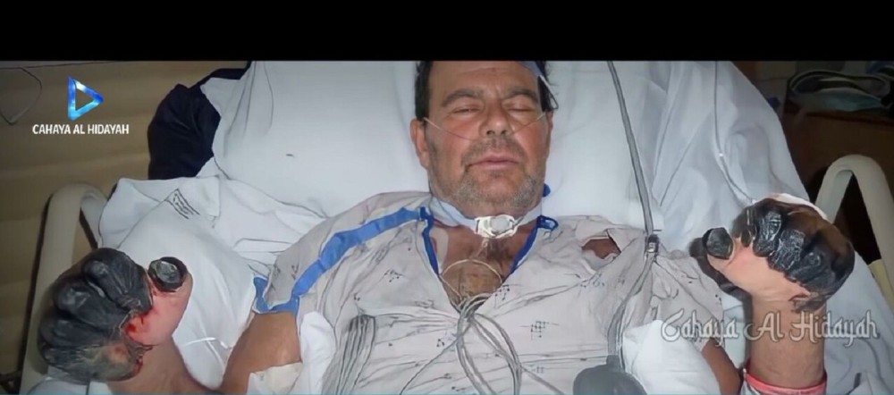 Pastor Ini Bakar Alquran, Malah Terbakar Tangan Sendiri, Akhirnya Ucap Syahadat