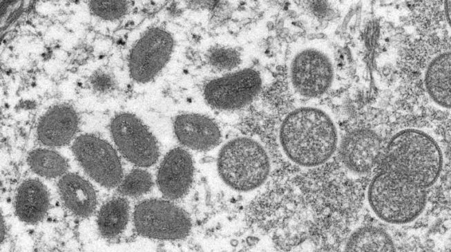 Virus Monkeypox Mulai Nyebar di Indonesia, Dokter Tifa Ungkap Asalnya: Melalui Orang yang Senang Berhubungan Sesama Jenis