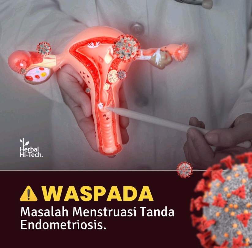 WASPADA MASALAH MENSTRUASI TANDA ENDOMETRIOSIS