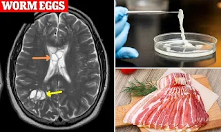 Ngeri... Ada Larva Cacing Pita di Otak Pria Ini gegara Makan Daging Babi