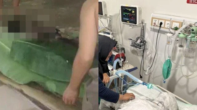 Tubuh Pria di Batam Terbakar Usai HP Meledak karena Dicas saat Tidur